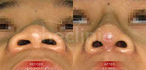 Nose Alar Reduction